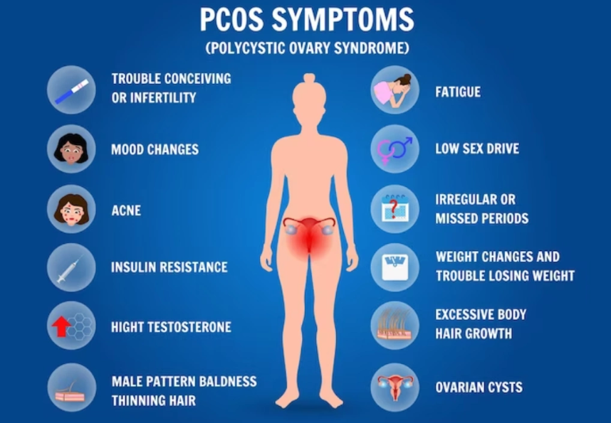 Menelisik Tantangan Diagnosis PCOS pada Perempuan