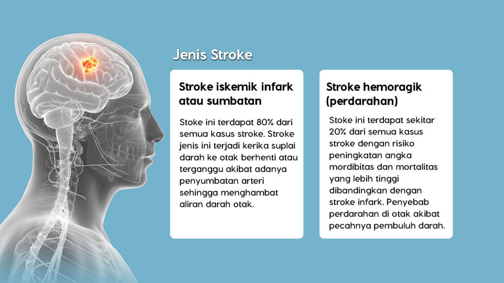 Menguak Fakta Stroke: Penyebab dan Pemulihannya